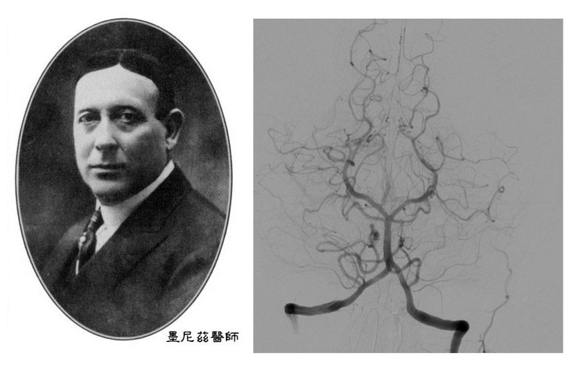 墨尼茲在1927年透過新方法拍攝得到清晰的腦血管照片（圖／（右）wikipedia，非當時照片）