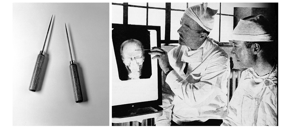 （左）富利曼進行腦葉切除術使用的工具（右）腦葉切除手術前觀看X光照片的富利曼（圖／wikipedia）