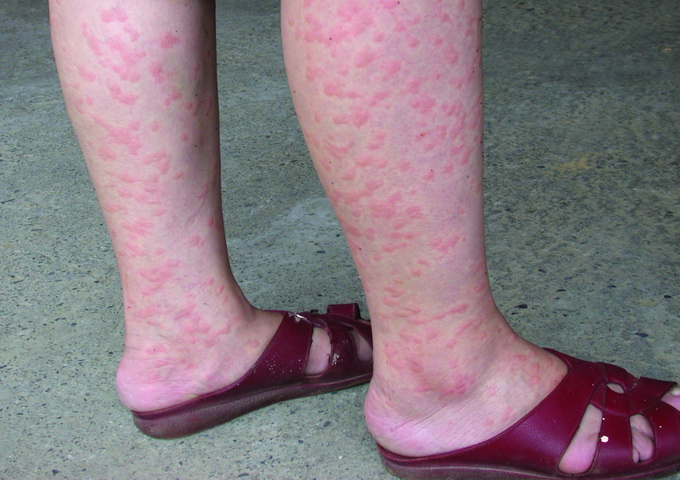 小黑蚊成群叮咬人體裸露的皮膚，受害部位隨即紅腫，奇癢難耐。