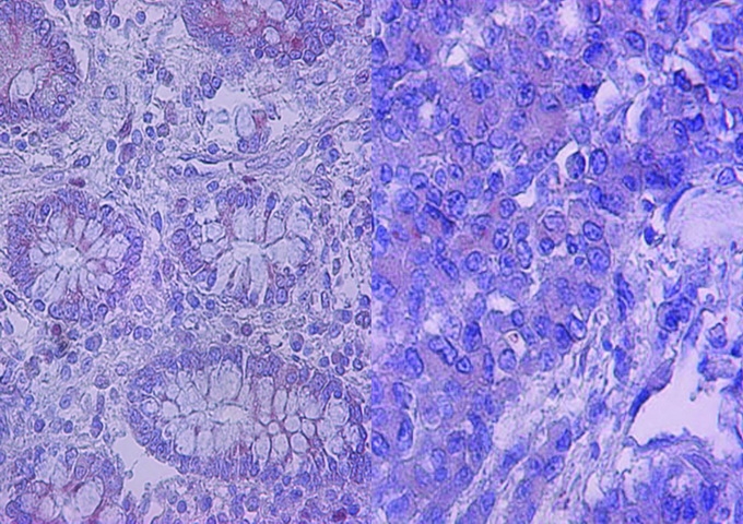 正常腸道上皮組織（左）及大腸直腸癌患者的腸道上皮組織（右）
