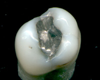 銀汞齊在牙科上常用來鑲填牙齒。（圖／Wikipedia）