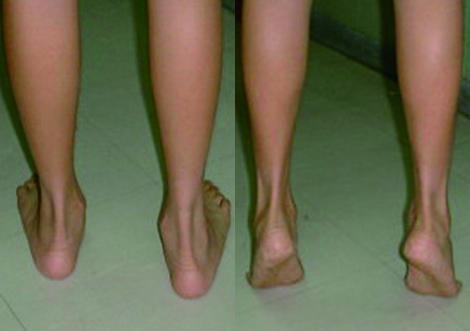 飼料雞型的扁平足在站立時足弓消失（左），但踮腳尖時足弓又出現（右）。