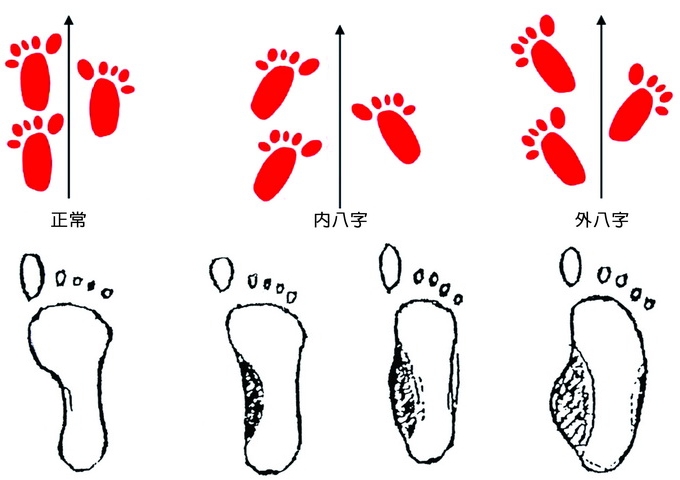 （上）內八字腳與外八字腳（下）最左至右是正常足弓，輕度、中度及重度扁平足。