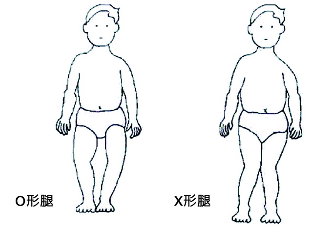 所謂的O、X型腿，是指站立時從正面看下肢的形狀而名之。
