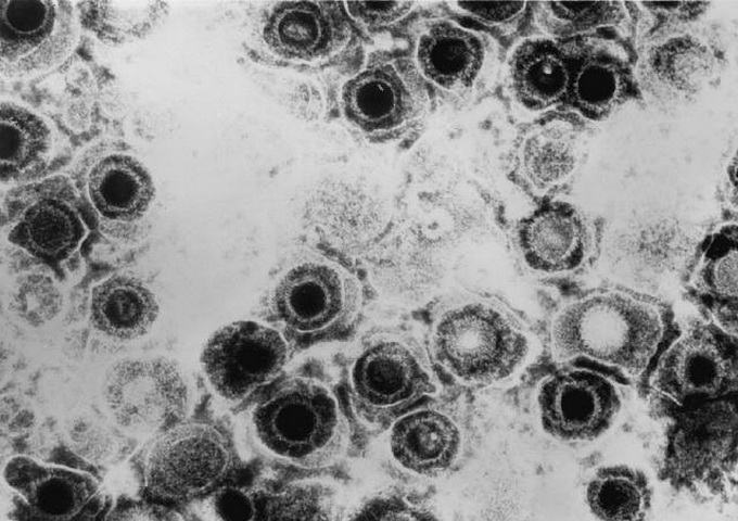 電子顯微鏡下的唇皰疹病毒（圖／Dr. Erskine Palmer，US CDC）。