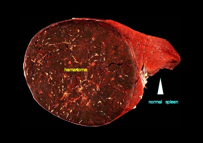 脾臟上的過誤瘤（hamartoma，暗褐色）與正常組織（圖／Ed Uthman拍攝，wikipedia）