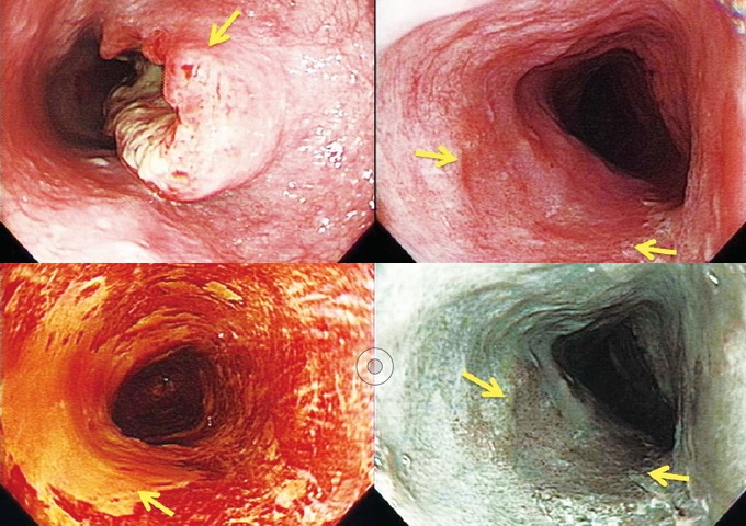 上圖為傳統食道內視鏡診斷，左為晚期，右為初期。下左在食道表面噴灑碘溶液，下右以窄頻影像技術觀察表層血管增生。