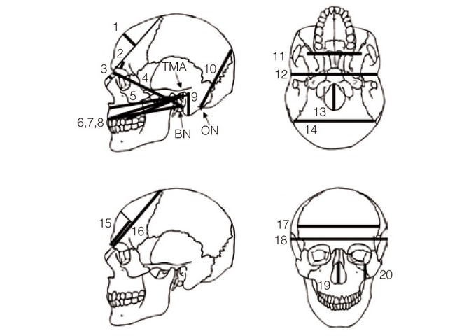 頭骨研究有許多測量項目，經由研究世界各人群的頭骨，已確定這些測量項目在人群間有差異，並藉此建立人群分類系統。（圖片來源：Roseman, C. C.（2004）PNAS, 101:12824 -12829.）