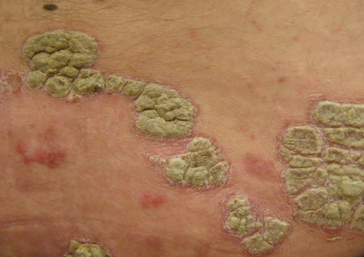 牛皮癬是一種「自體免疫系統失調」造成的疾病