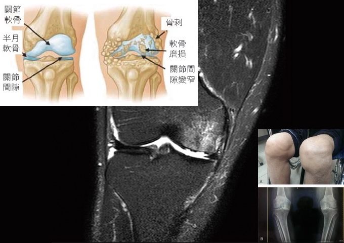 腫脹變形的雙邊膝關節，雙邊膝關節的Ｘ光片，及膝關節MRI影像。