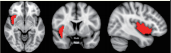 紅色區域顯示由腦部上面、前面及側面所觀察到的腦島位置。