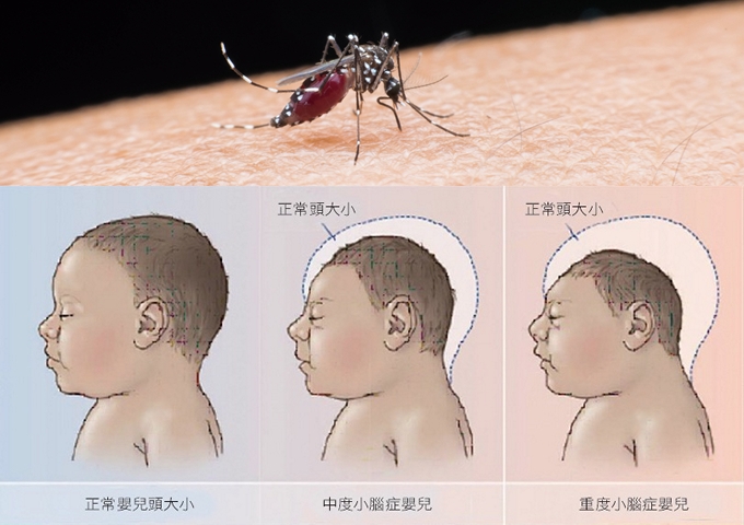 茲卡病毒造成胎兒小腦症。（圖／Petersen, L.R., D.J. Jamieson, A.M. Powers, and M.A. Honein (2016) From Zika virus. N. Engl. J. Med., 374, 1552−1563）
