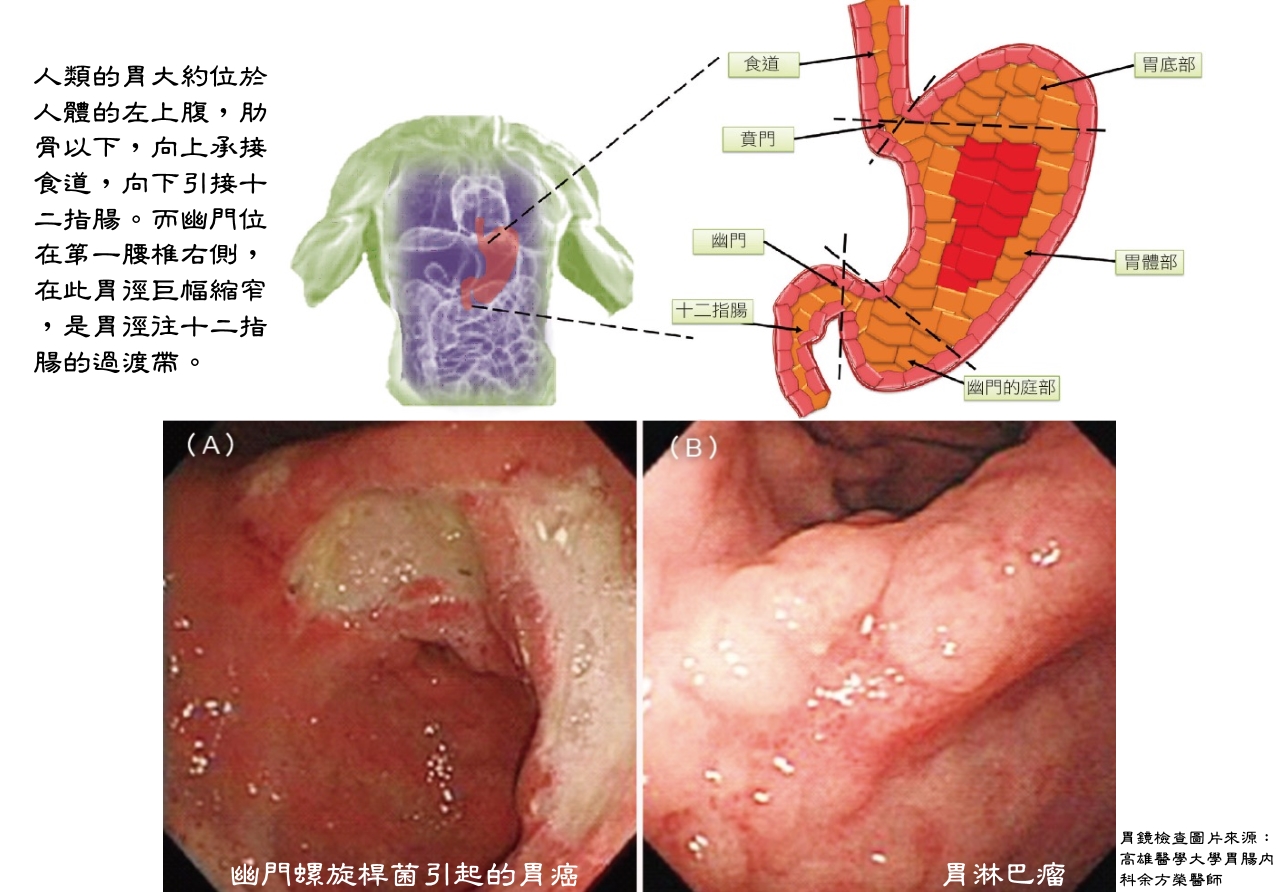 人的胃大約位於人體的左上腹，肋骨以下，幽門螺旋桿菌會引起胃癌以及胃淋巴瘤。
