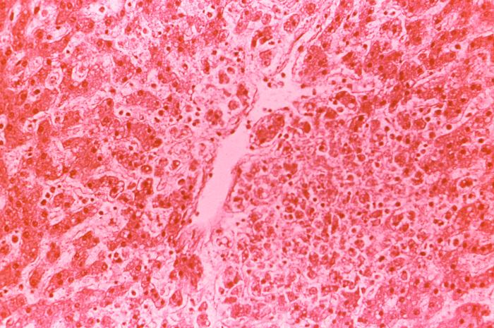 此為豋革出血熱症狀的肝臟組織切片，可看出。圖片來源：CDC PHIL