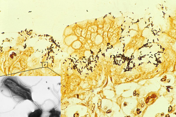 患者感染之胃黏膜上皮組織圖像與其放大圖。(圖片來源：藤田保健衛生大學醫學部 堤寛 教授)