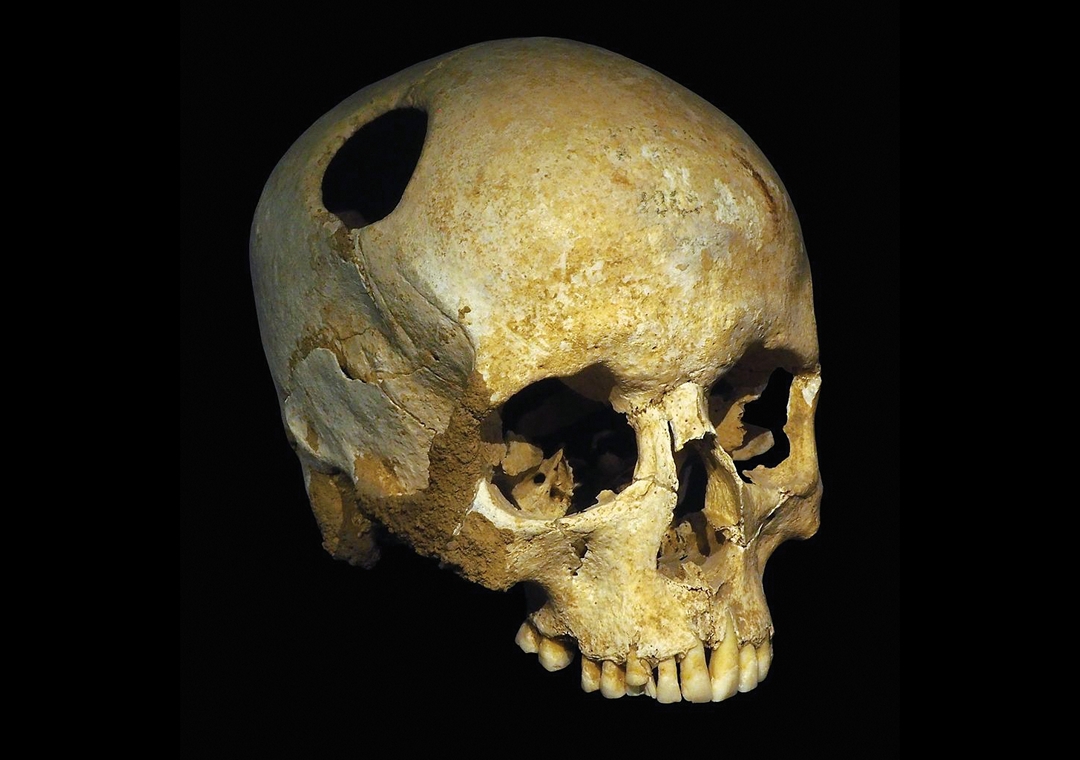3,500年前的穿顱手術，創口有明顯的癒合痕跡。這名婦人活到50歲，在新石器時代算是高壽。（出土於瑞士日內瓦湖北岸墓葬，現藏於洛桑考古暨歷史博物館。）
