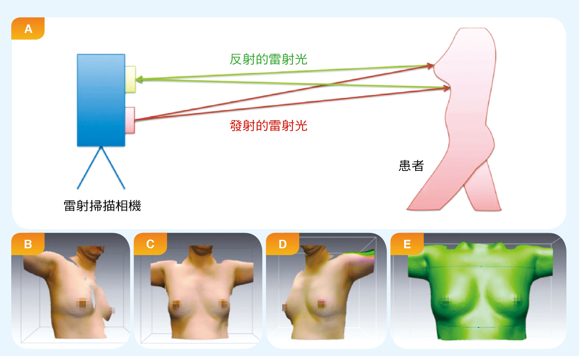 圖A顯示以雷射掃描相機掃描患者取得其乳房與周邊胸廓資料。圖B～D分別是患者正對雷射波束不同角度（－30°, 0°, 30°）的輸出影像圖。圖E是把圖B～D的資料合併後，以電腦軟體建立的患者數位模型表面圖。