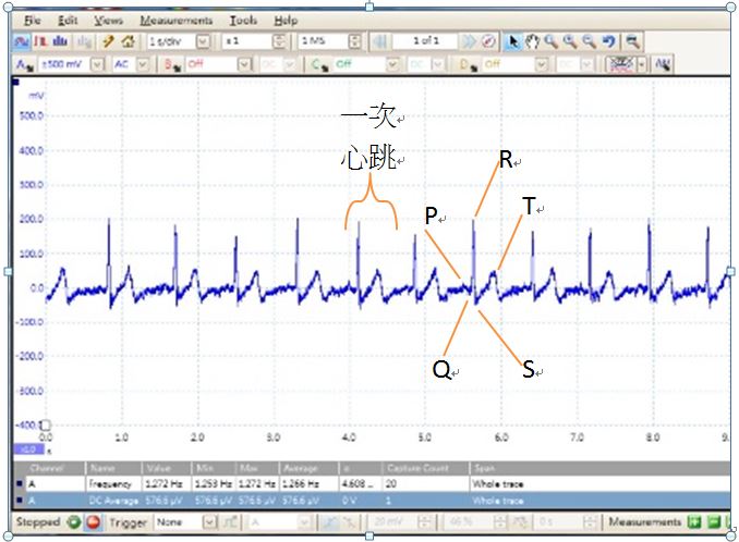 圖二：心電訊號波形圖。感測器透過貼片接收心電訊號，訊號處理後傳到行動裝置，行動裝置再演算處理訊號並顯示心電波形。心電圖是有規律的波形，容易算出心跳率，且每次跳動都隱含著心臟內部訊息。（圖片來源：國立中山大學-嵌入式系統實驗室）