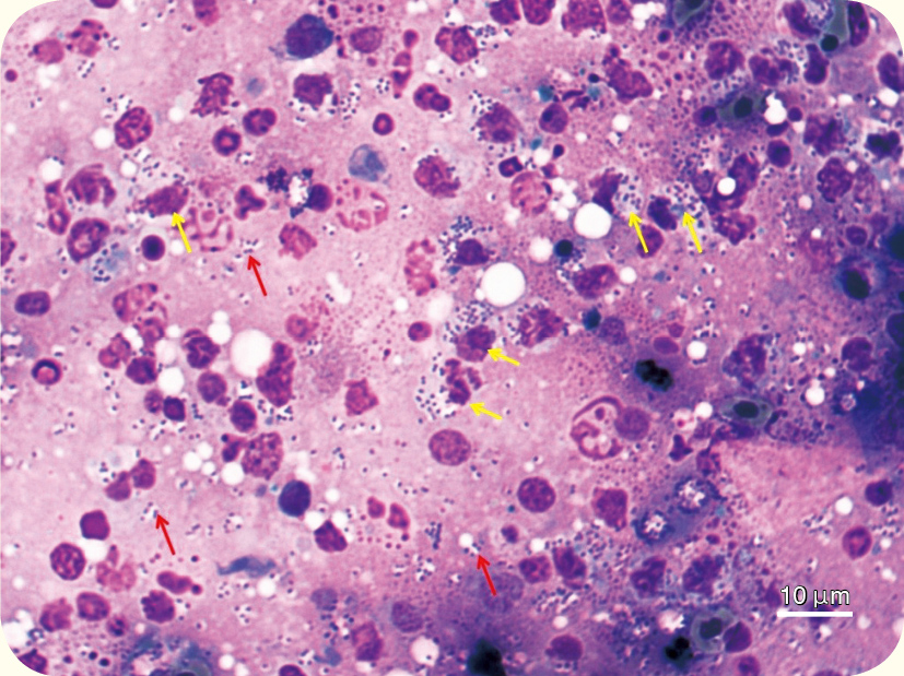 鏈球菌感染的魚脾臟組織經臟器塗抹後行經劉氏染色，在光學顯微鏡下可看到多量鏈球菌（紅色箭頭）與吞噬鏈球菌的白血球細胞（黃色箭頭）。