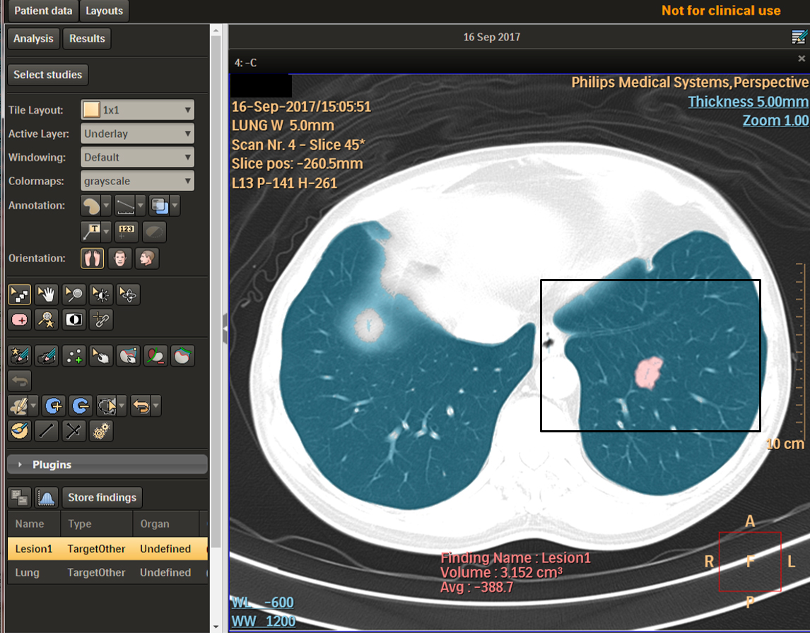 為了提供台灣醫療 AI 最優良之訓練資料，北醫團隊領先世界率針對肺部電腦斷層掃描進行深度標註。(圖片來源：計畫團隊提供)