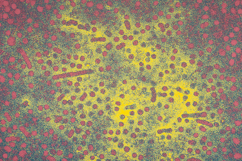 肝炎的成因包含病毒感染，如B型肝炎病毒和C型肝炎病毒等等。圖為B型肝炎病毒的電子顯微照片。（圖／Sanofi Pasteur，Flickr）