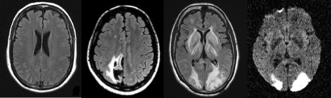 左一為正常大腦，由左至右為腦出血、腦中風及腦水腫的樣子。（圖／陳世彬提供）