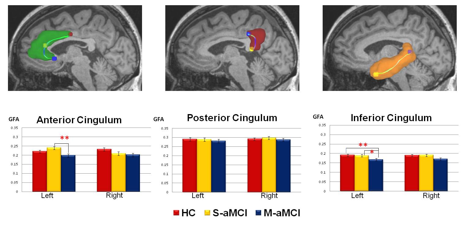 不同類型之早期MCI 患者，可由腦中白質例如扣帶迴中連結海馬迴的部分（最右側圖）辨別出來。（圖／Journal of Alzheimer’s Disease）