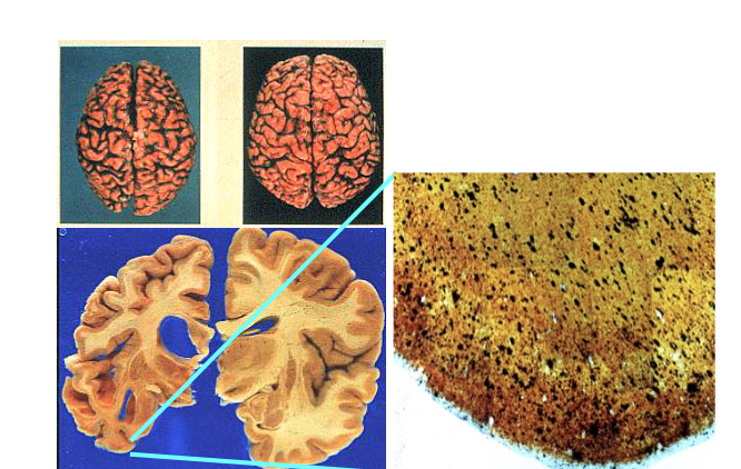 （左上圖）左邊是阿茲海默症病人的大腦，腦部白質嚴重萎縮，灰質（即神經細胞）大量死亡，細胞跟細胞之間的連結也變得稀疏，導致訊息不能傳遞。（左下、右圖）腦部放大解剖的黑色部分就是老化斑塊，裡面隱藏的即是類澱粉蛋白。（圖／白明奇、郭余民提供）