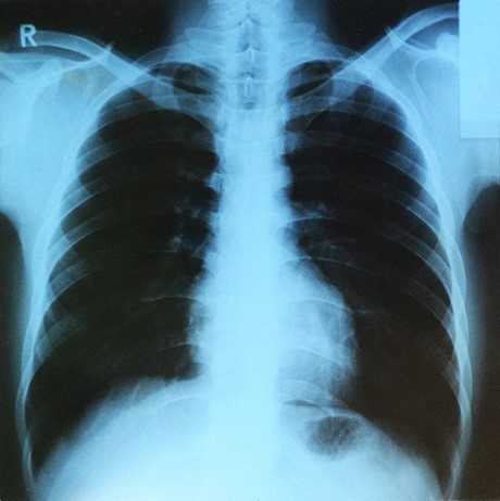 胸腔照射x光
