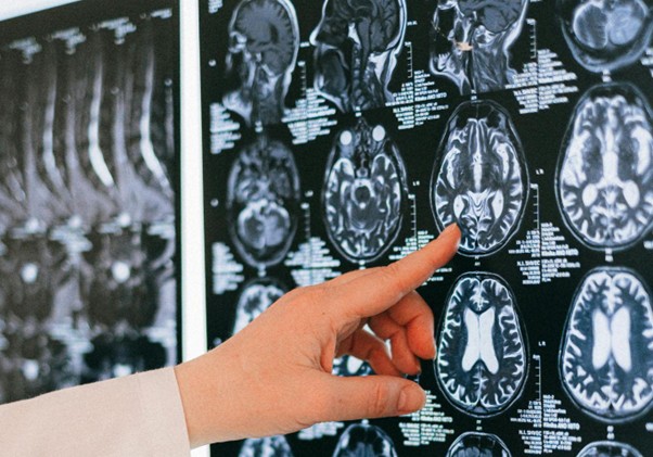 阿茲海默症的新防線：從基因預測到代謝介入